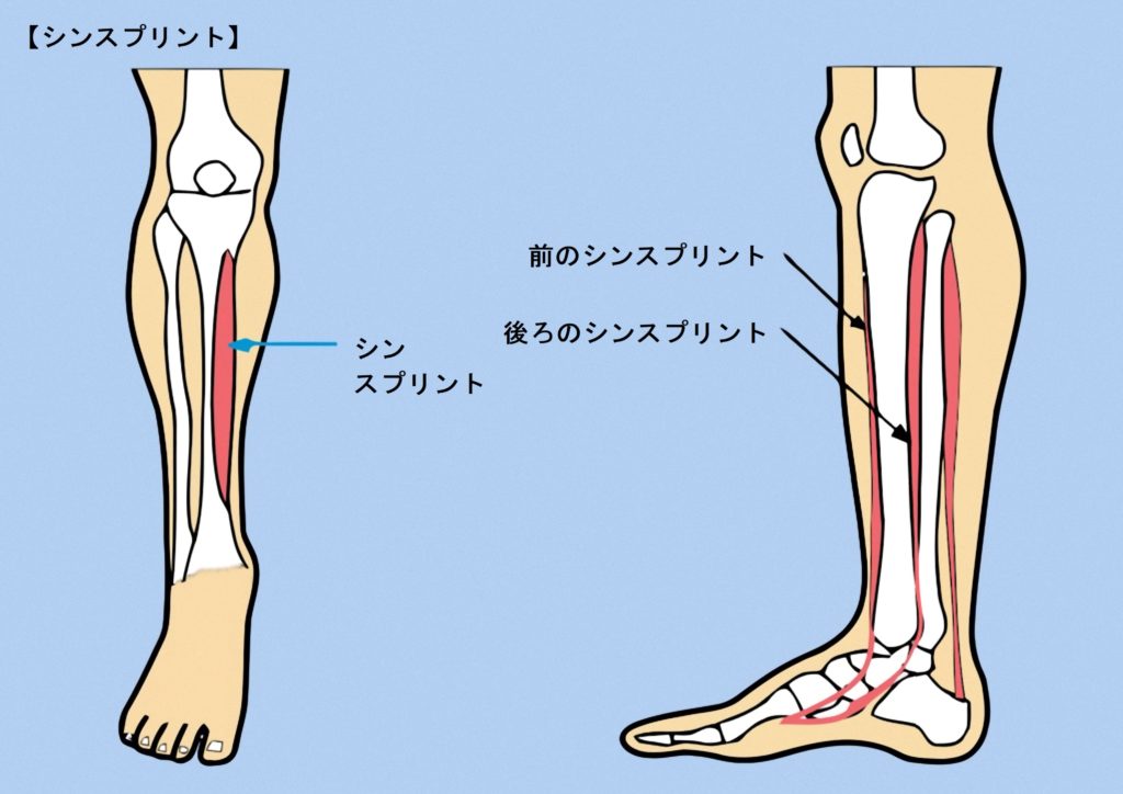 すねの内側の痛み シンスプリント 外反母趾改善 大阪河内長野市の足専門院