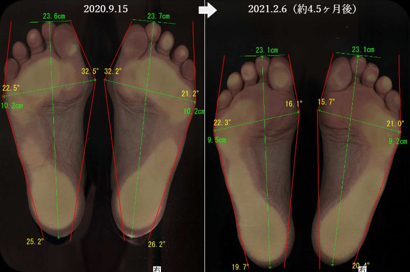 外反母趾改善 大阪河内長野市の足専門院 南花台田辺整体院