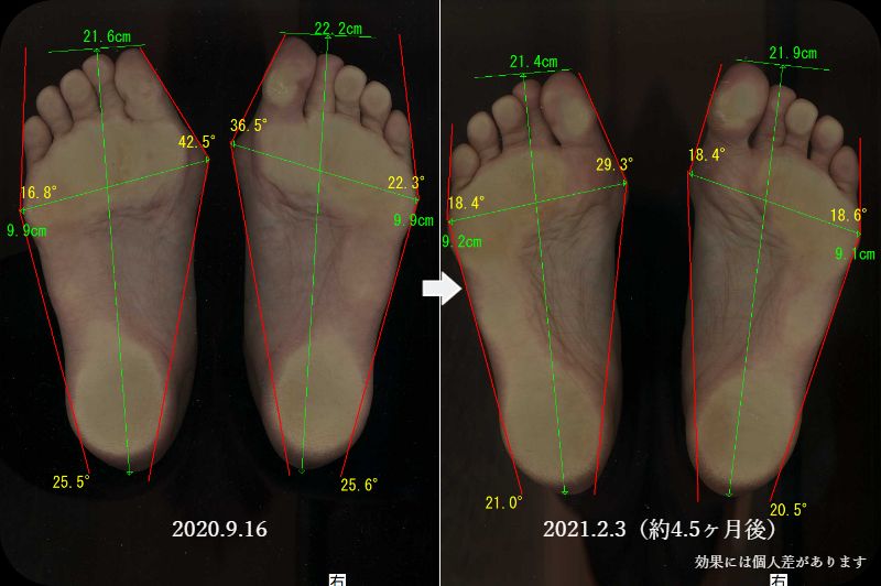 外反母趾改善 大阪河内長野市の足専門院 南花台田辺整体院