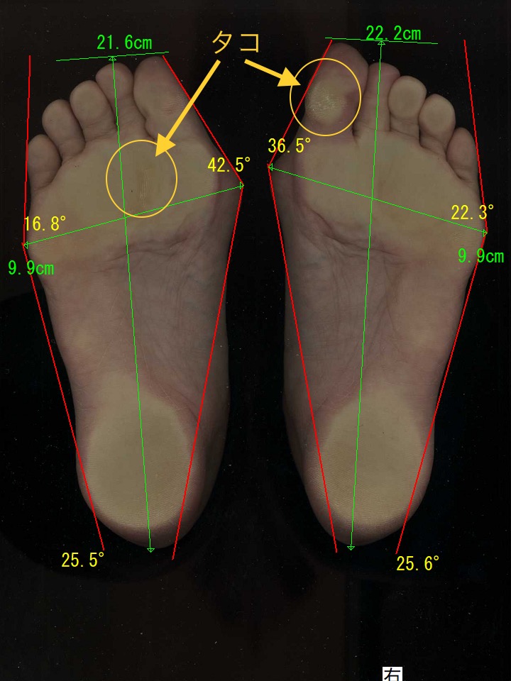 中学生の頃から削り続けた足裏のタコ 外反母趾 ヘルニアによる足の痛み 痺れが改善した方 大阪府羽曳野市 40代病院勤務 外反母趾 の専門整体 南花台田辺整体院 大阪河内長野市の足専門院